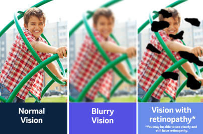 three side by side images of a child on a playset one labeled normal vision one blurry vision and one vision with retinopathy. Each image is altered to match how it might appear to someone with those conditions.