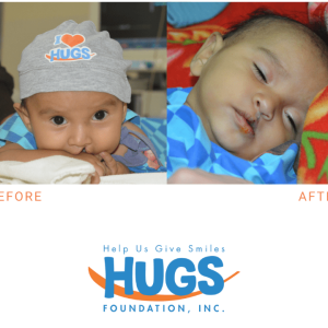 A child's before and after photo from surgery