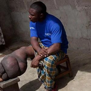 a person with LF rests their leg on a stool